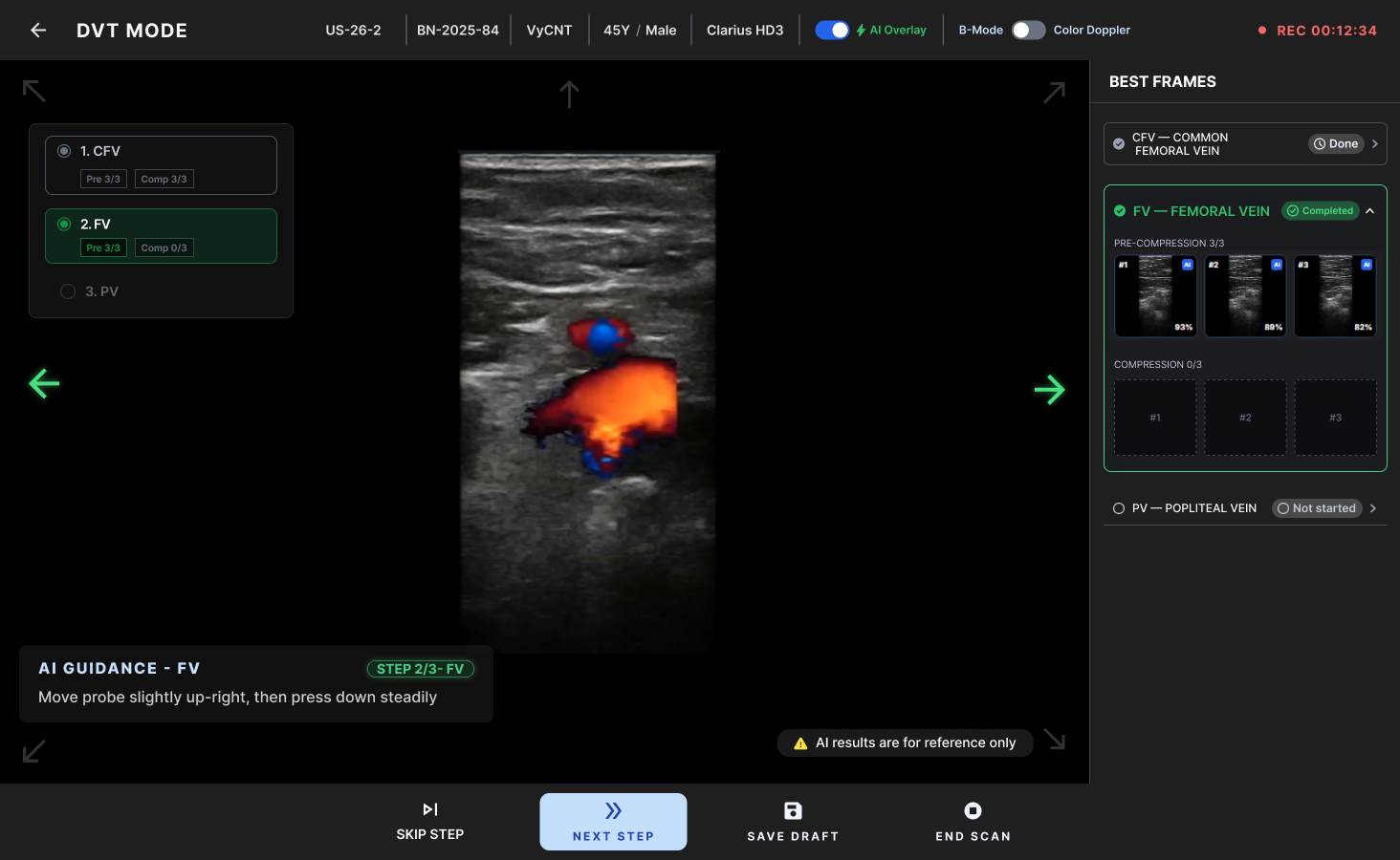 SonoMate DVT Mode: checkpoint guidance and selected ultrasound frames for review.