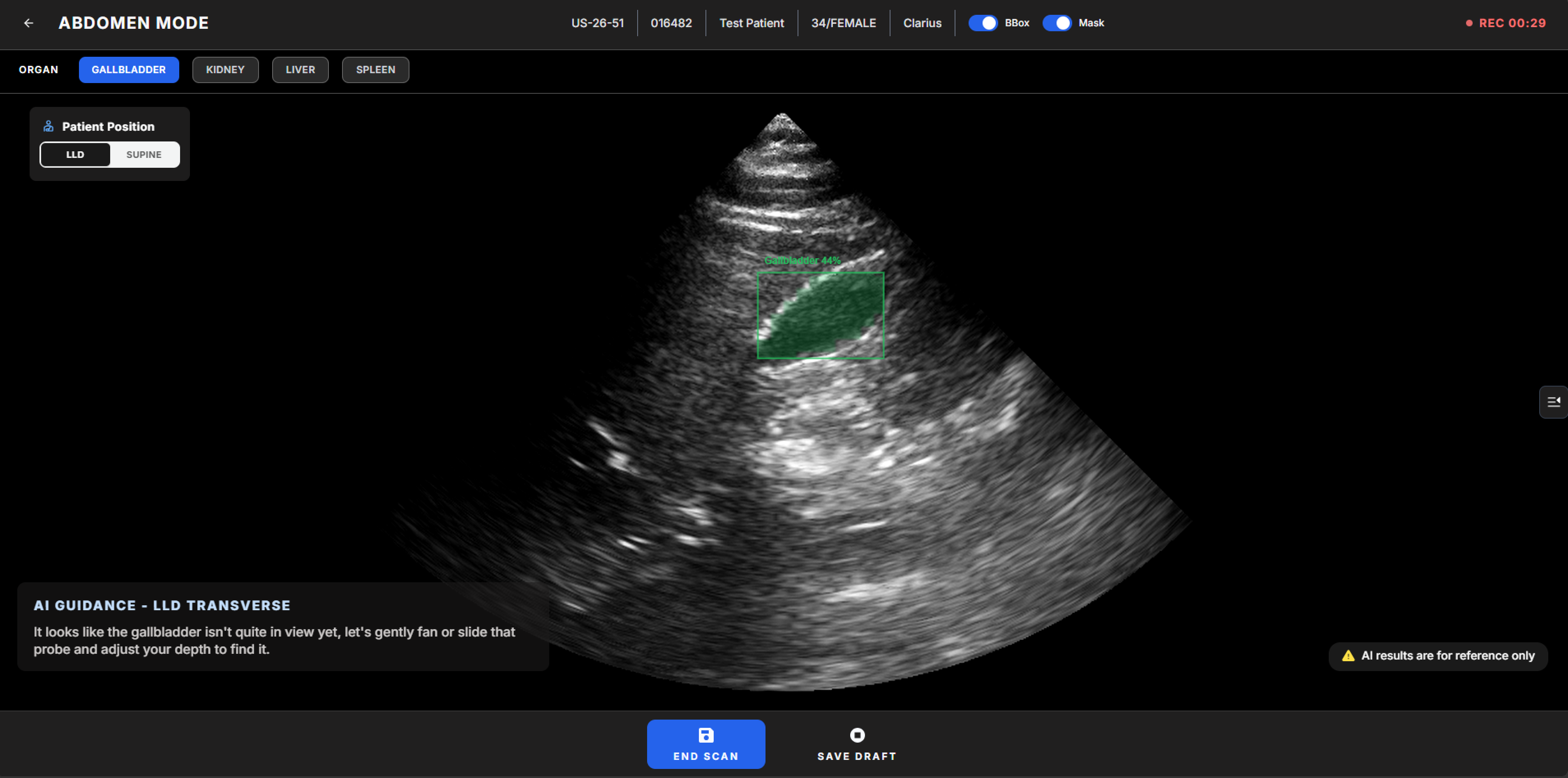 SonoMate Abdomen Mode: real-time acquisition guidance and best-frame support.